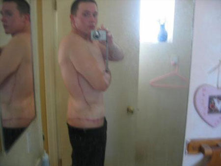Before and After Losing 180kg Before and After Losing 180kg