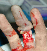 Don’t wear ring in heavy labour job