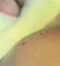 World’s Biggest Zit
