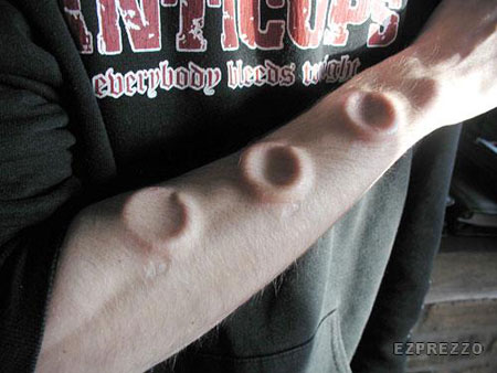 Body Implant Body Implant