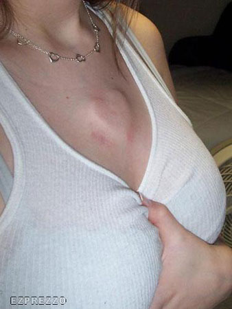 Body Implant
