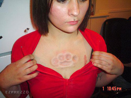 Body Implant