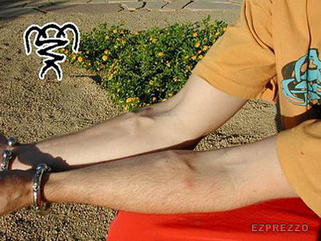 Body Implant